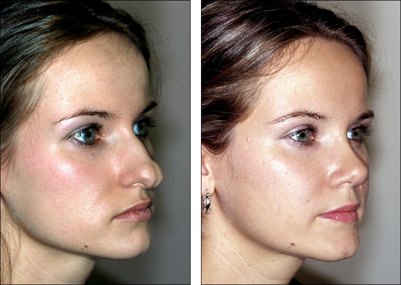 Essential information of Rhinoplasty