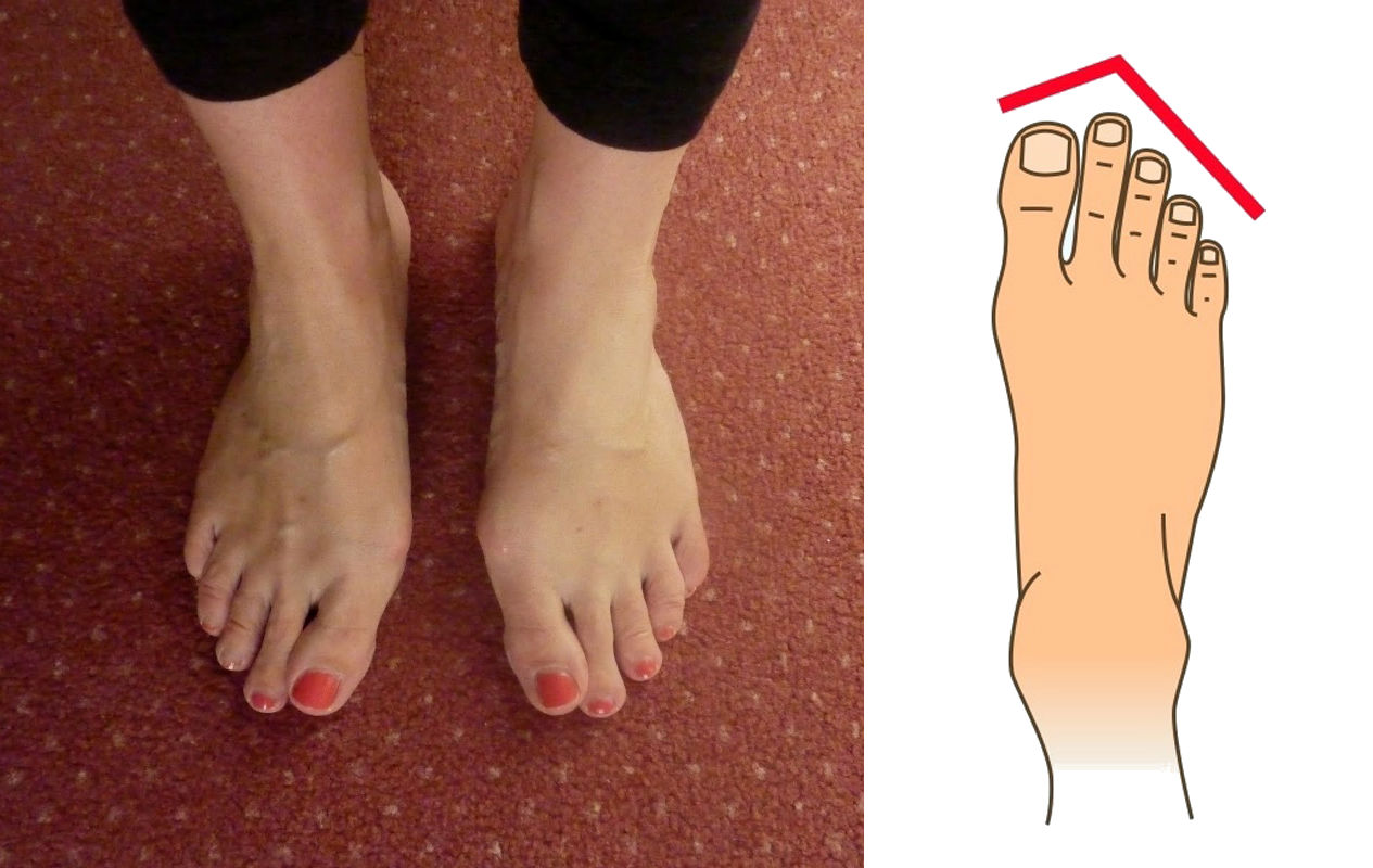 Foot Shapes Which Reveal Secrets about Your Personality  